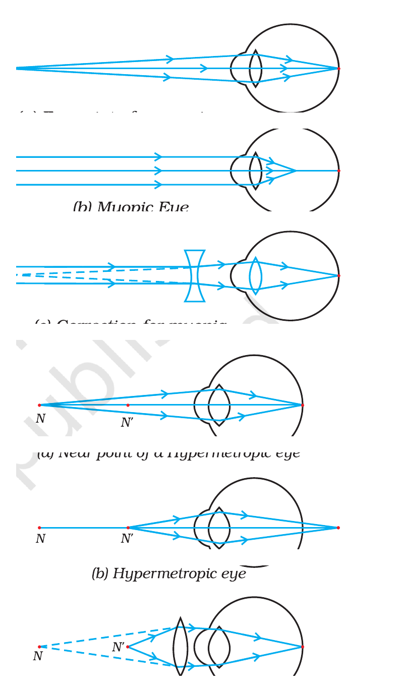 NCERT ray diagrams showing myopia and hypermetropia and their correction with suitable lenses.